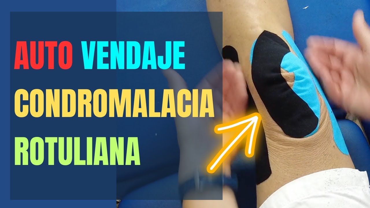 Auto Vendaje Neuromuscular para la Condromalacia Rotuliana