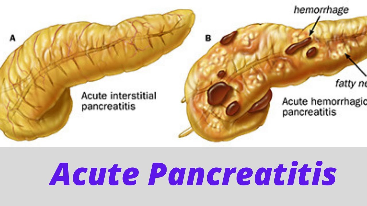 Acute pancreatitis