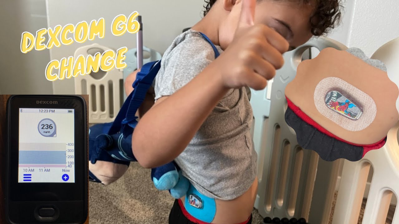 First Dexcom G6 Site Change