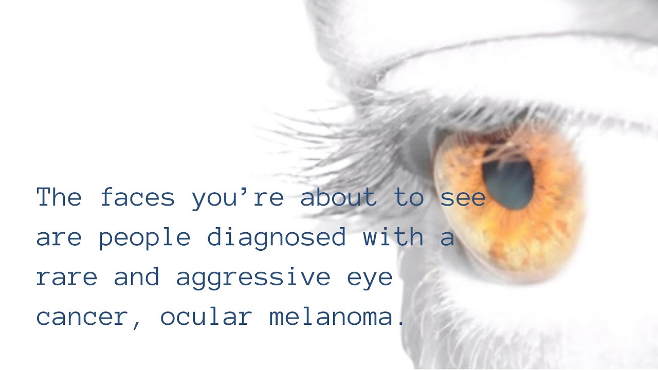 The Faces of Ocular Melanoma