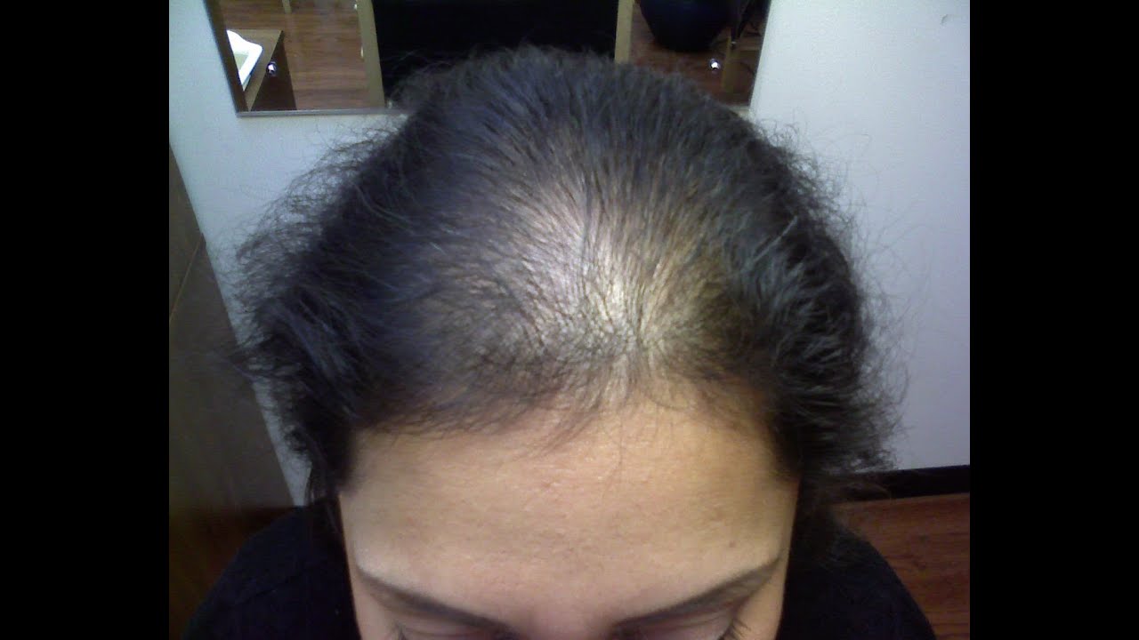 Rapid Hair Loss - Telegen Effluvium [DermTV.com Epi 