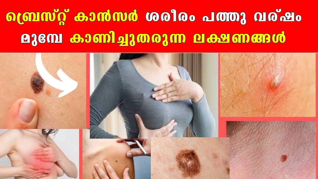 ബ്രെസ്റ്റ് കാൻസർ ശരീരം പത്തു വര്ഷം മുമ്പേ കാണിച്ചുതരുന്ന ലക്ഷണങ്ങൾ /Baiju's Vlogs /Dr Padmakumar