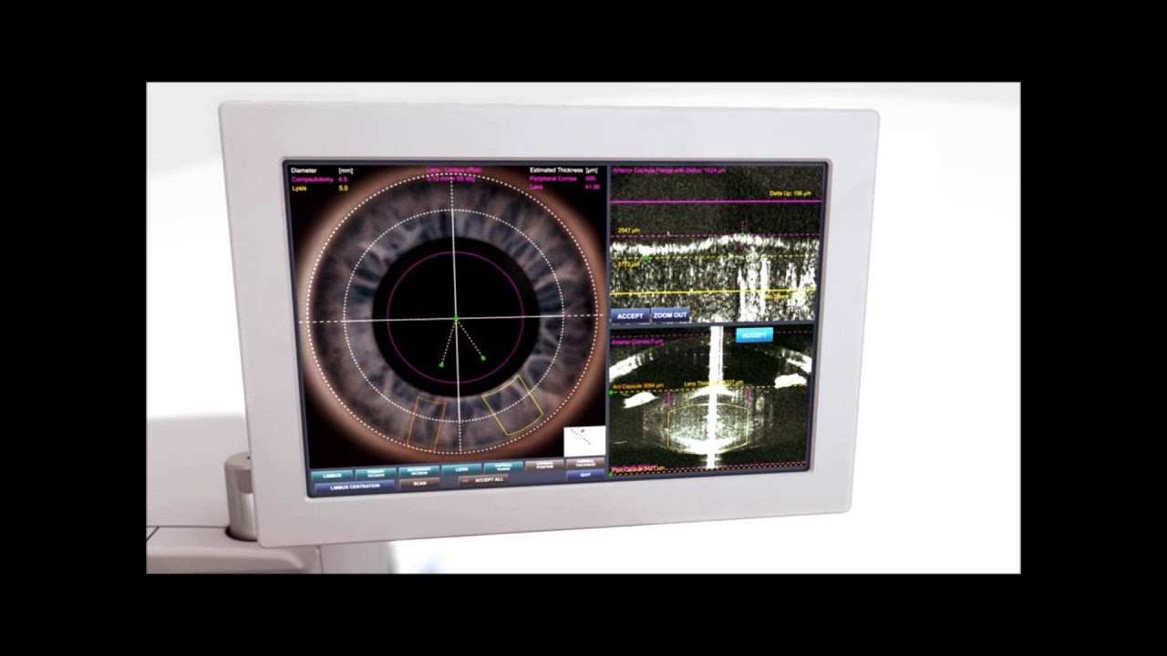 Bladeless Laser Cataract Surgery at The Eye Associates