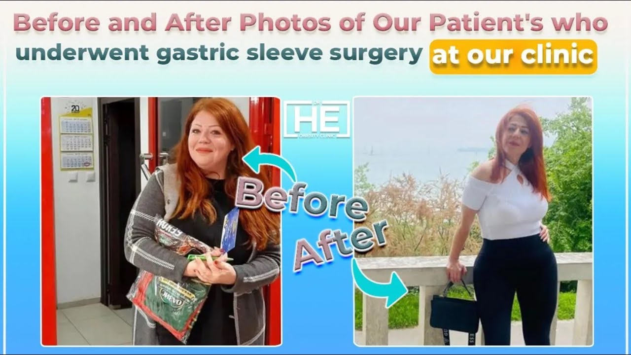 Inspiring Journey: Before and After Photos of Our Patient's Who Underwent Gastric Sleeve in Turkey