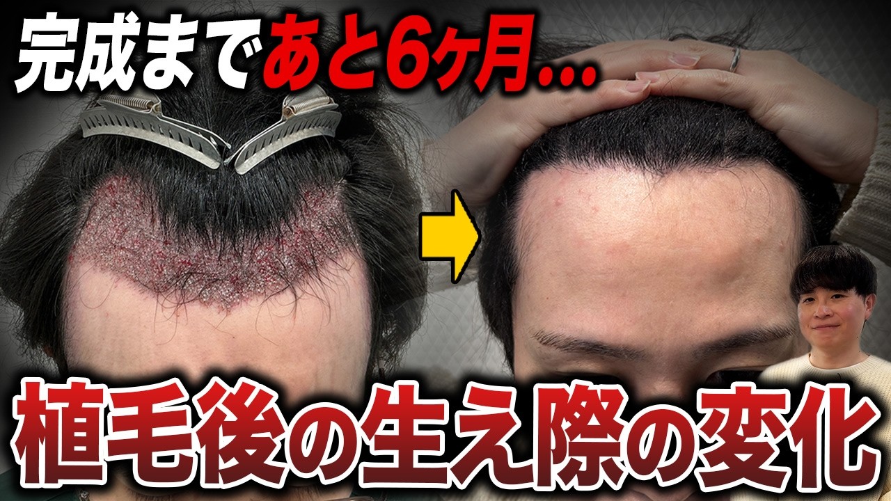 【M字薄毛】植毛6ヶ月はどこまで変わる？リアル途中結果