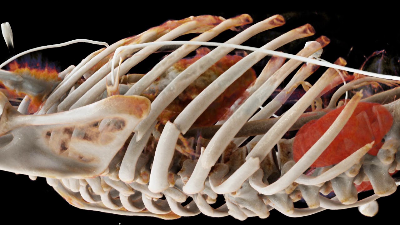 CT Polytrauma