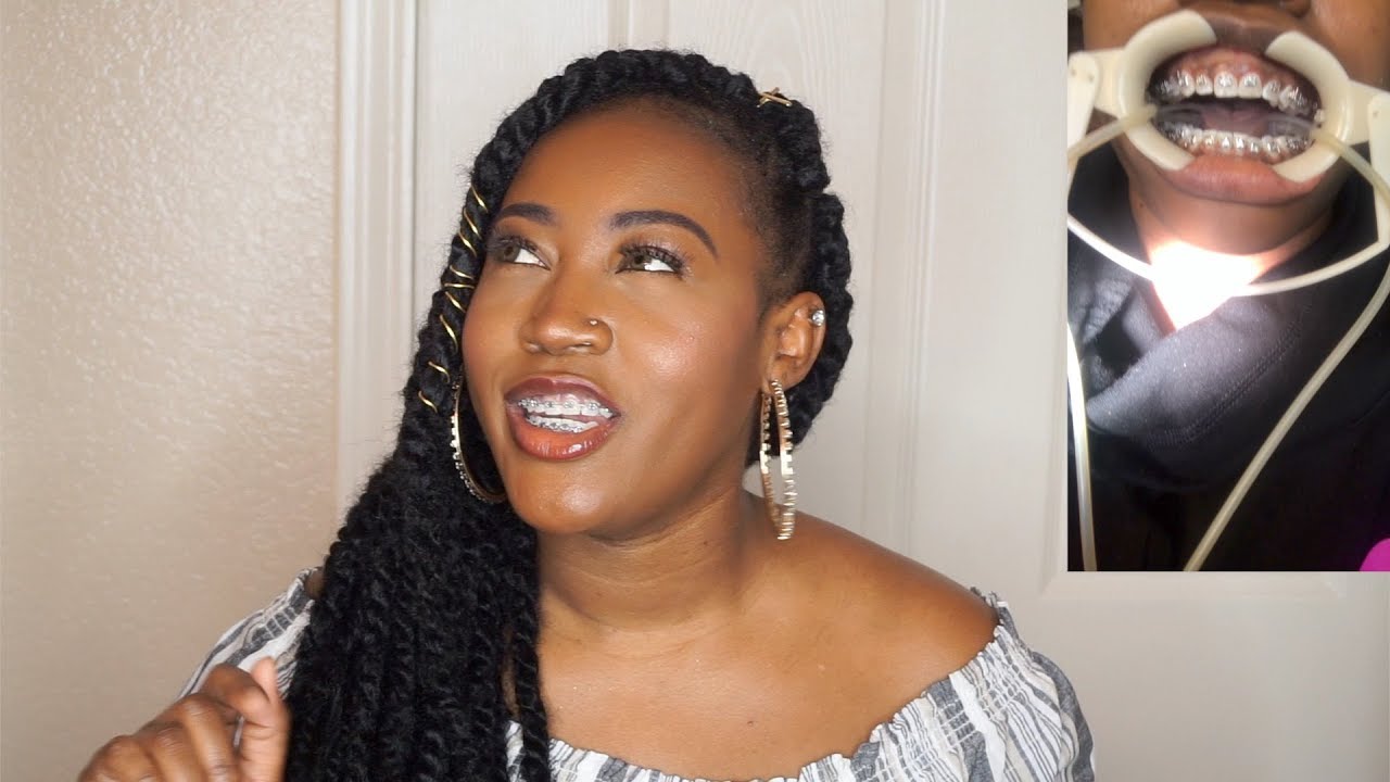 My Braces Journey..Second Time Around| Cost, Swollen Gums, Depression, Too Old?...