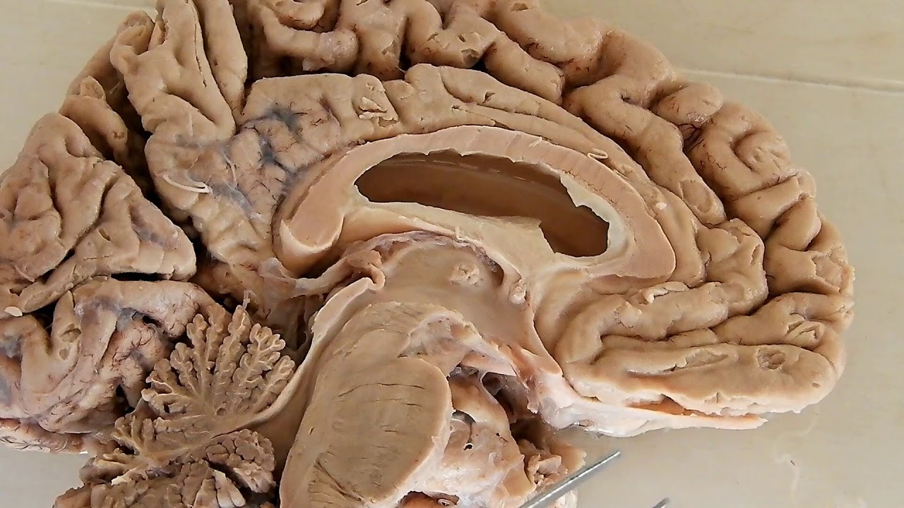 Third Ventricle / neuroanatomy / boundaries / recesses