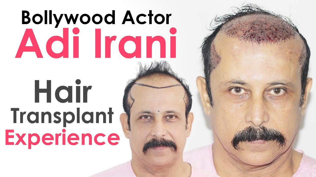 Bollywood Actor Adi Irani Shares Hair Transplant Experience with Dr Suneet Soni | Medispa India