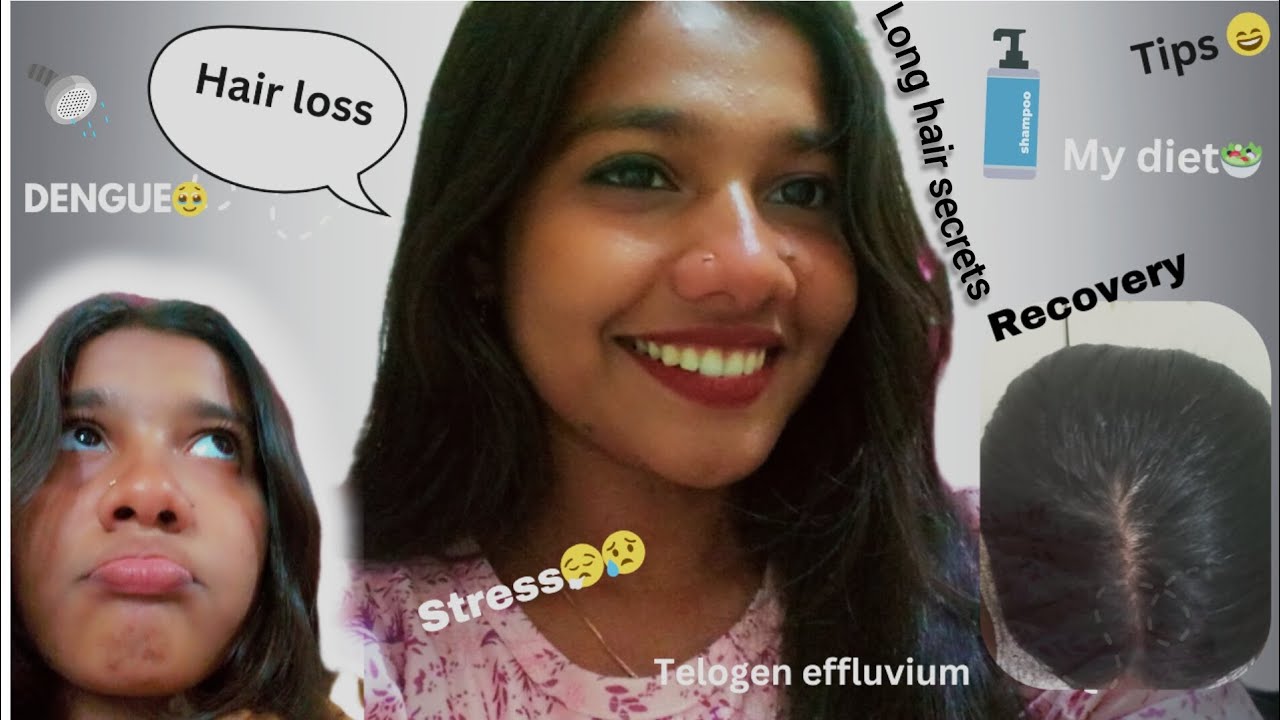 Why did I lose 50% of my hair?😭|Telogen effluvium| Recovery🤌🏻