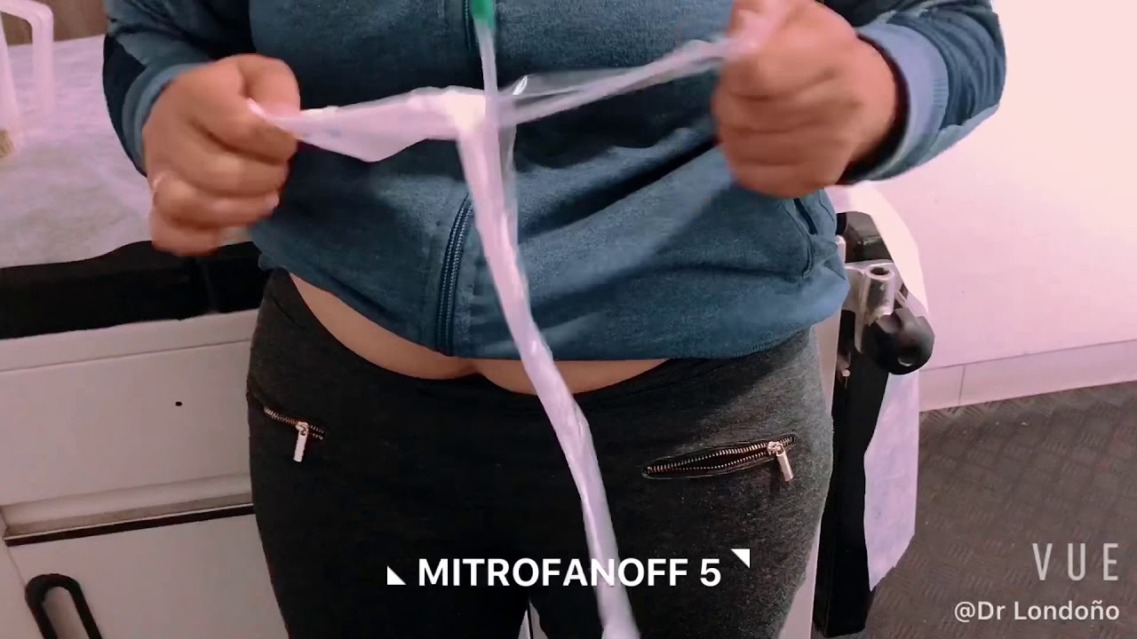 MITROANOFF 5 - MÓNICA TÉCNICA AUTOCATETERISMO Y TESTIMONIO