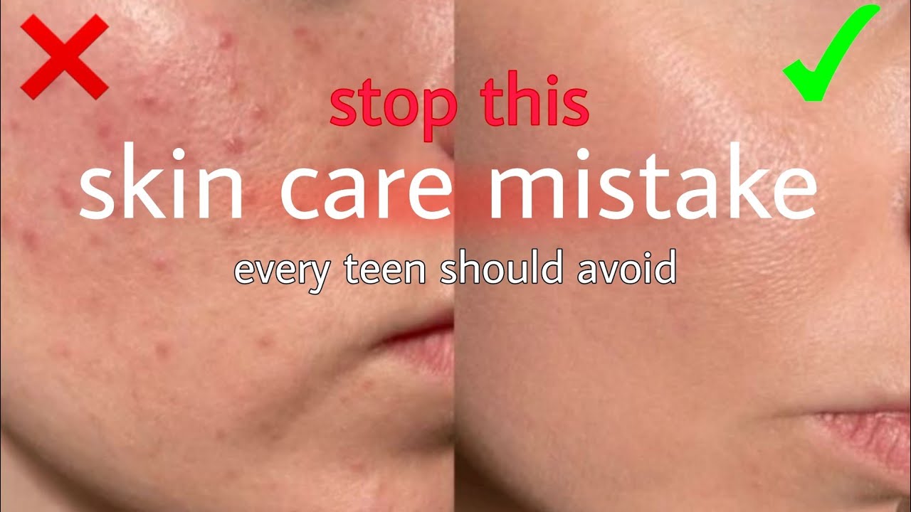 “Skincare Mistakes Teenagers Should Stop Doing!”❌❗( say goodbye to breakout)