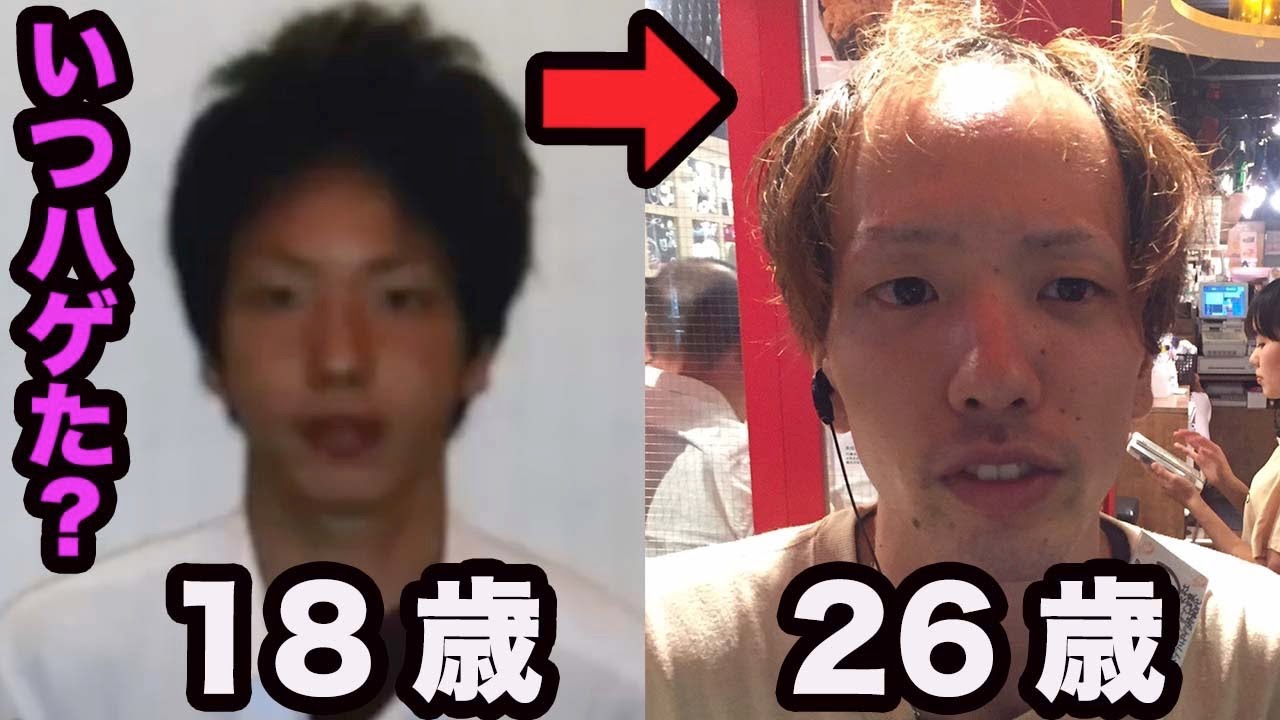 【おでこ生え際はいつ後退？】1年毎に過去写真振り返ってみた