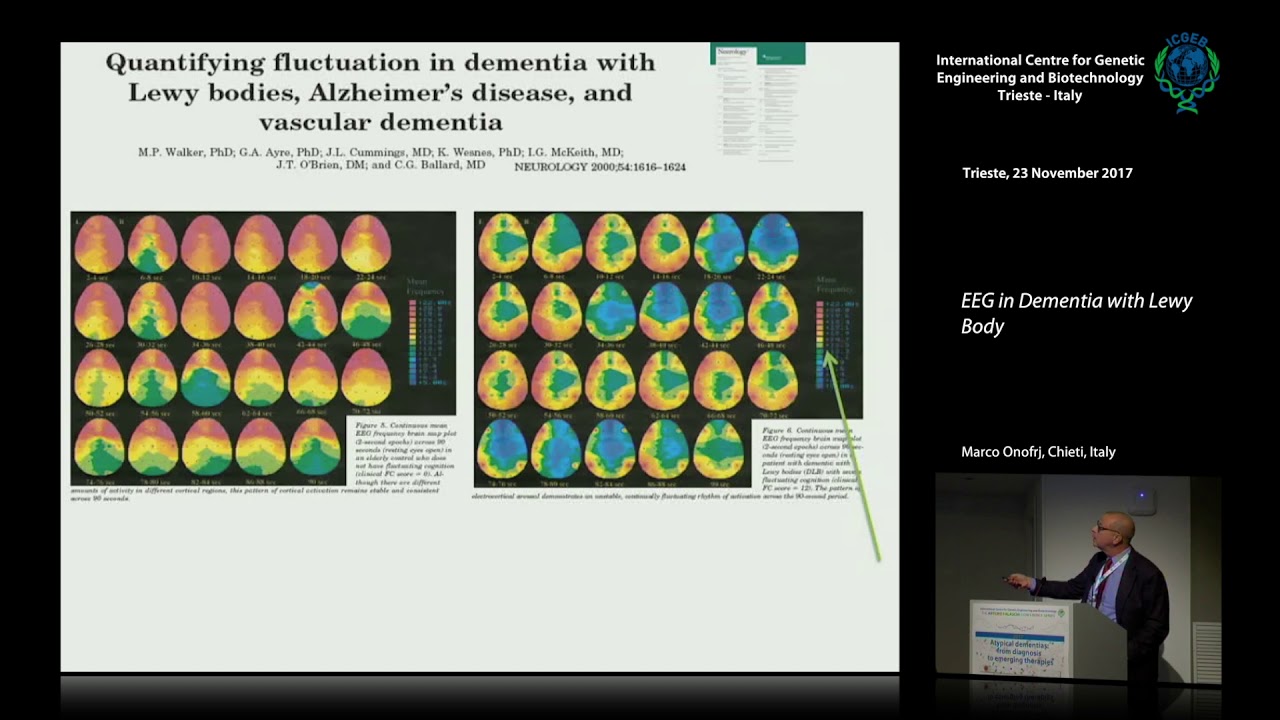 M. Onofrj - EEG in Dementia with Lewy Body