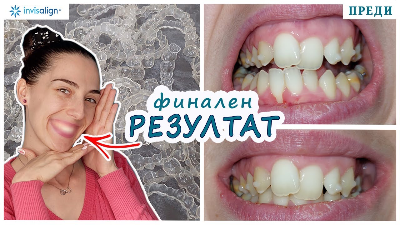 Новата ми усмивка след 18 м с алайнери еп.7