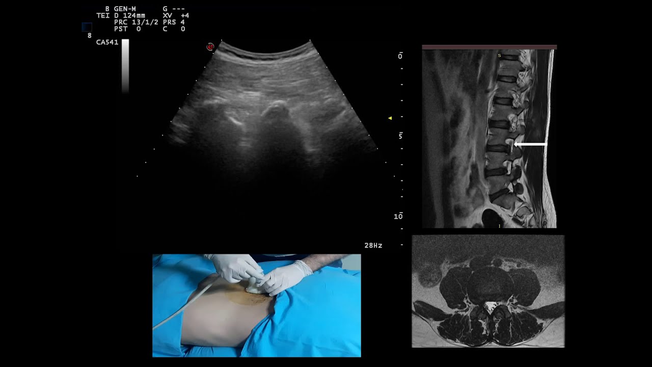 Ultrasound guided transforaminal epidural steroid injection