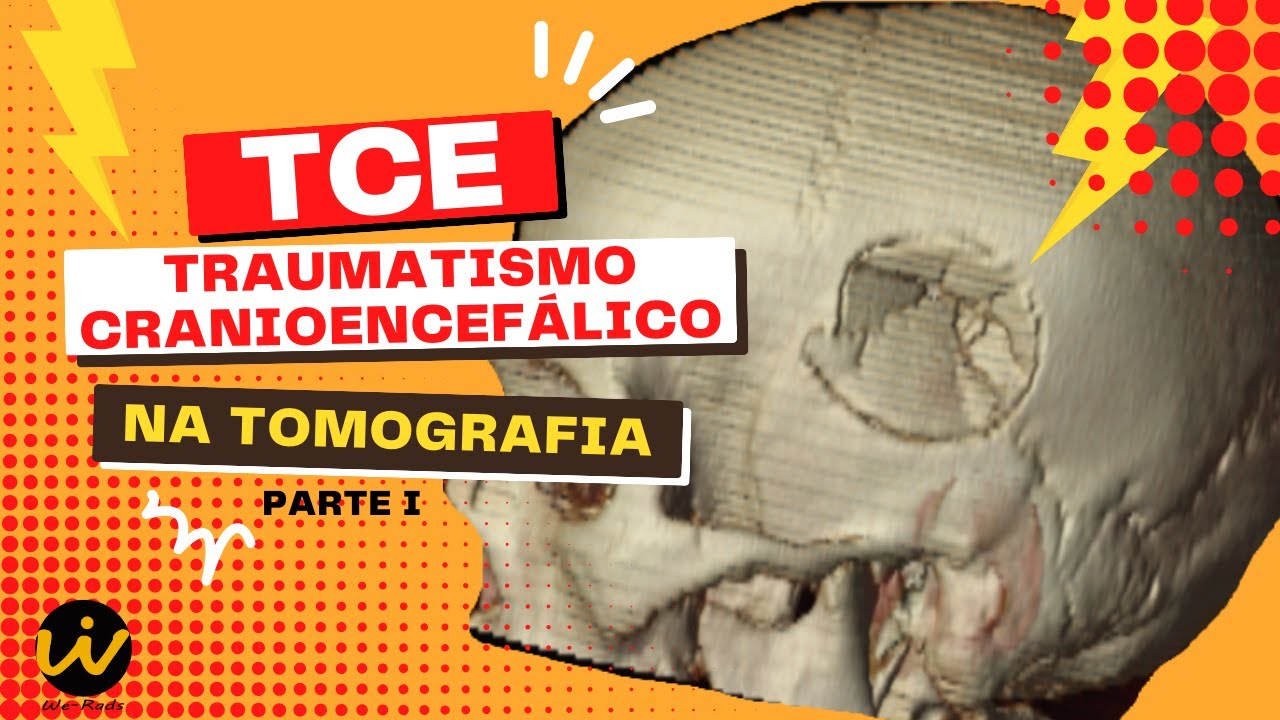 TRAUMATISMO CRANIOENCEFÁLICO / TCE - Tomografia de Crânio no Trauma Parte I