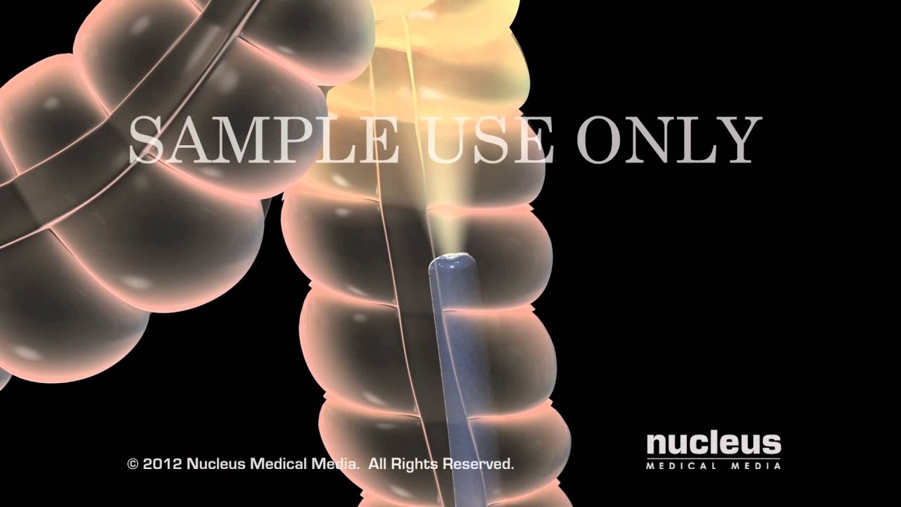 Endoscop&iacute;a del tracto gastrointestinal inferior