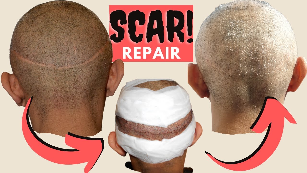 Hair Transplant Results | FUT Hair Transplant Scar | Scar Revision