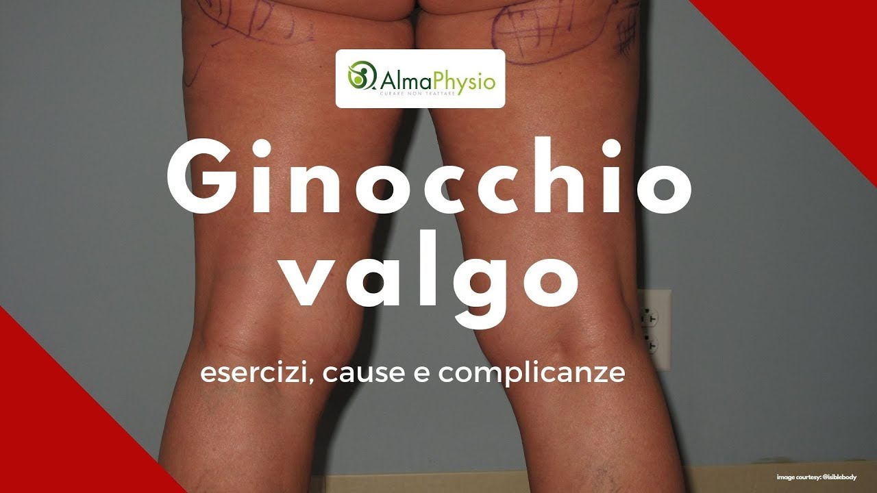 ginocchio valgo: esercizi, cause e complicanze (SPIEGAZIONE COMPLETA!!!)