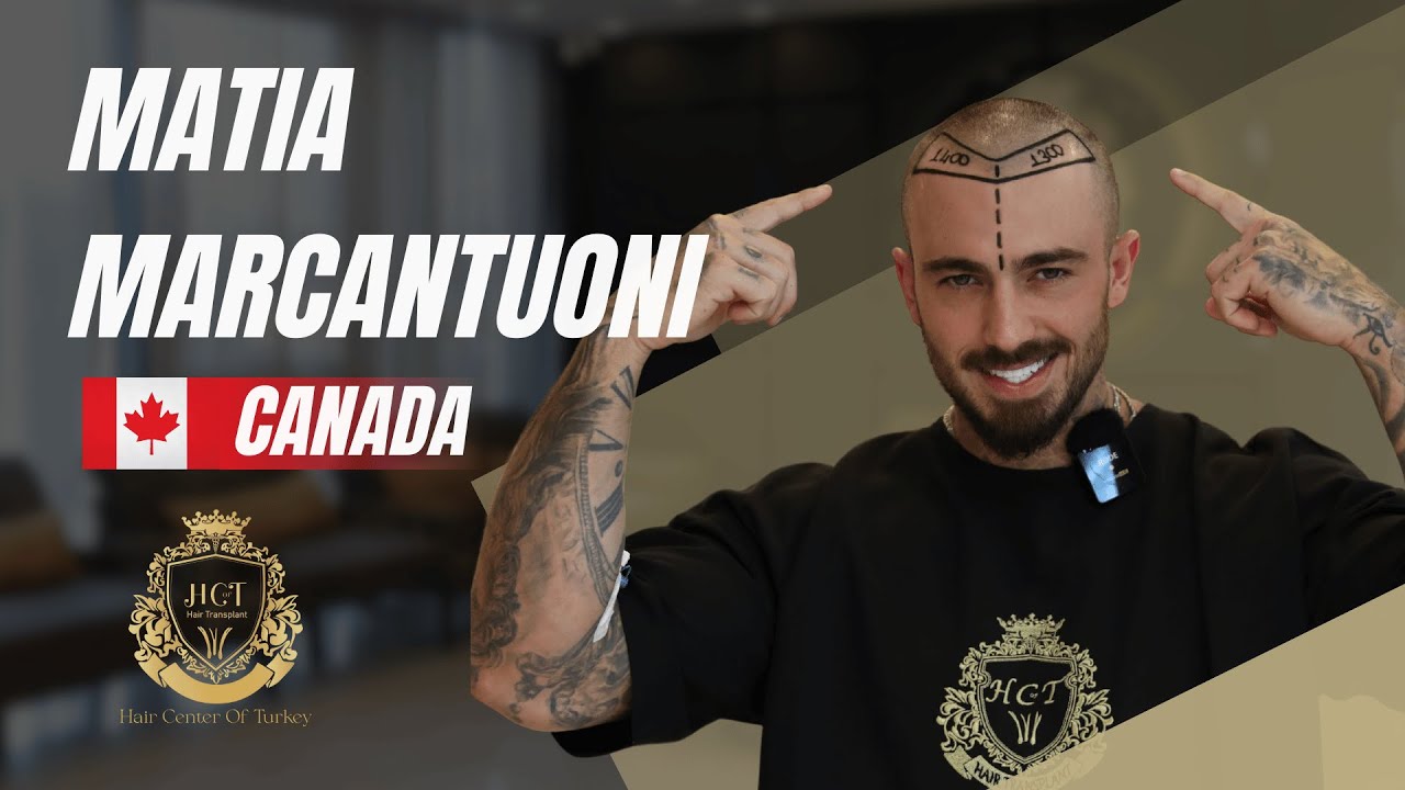 Hair Transplant in Turkey | Matia Marcantuoni Hair Transplant Review | Hair Center of Turkey