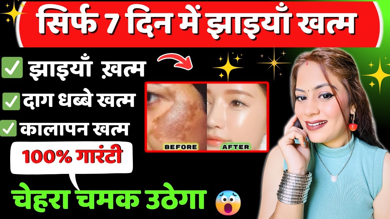 Jhaiya Khatam Karne Ka Tarika | How to Remove Pigmentation Permanently | झाइयों का घरेलू उपाय 