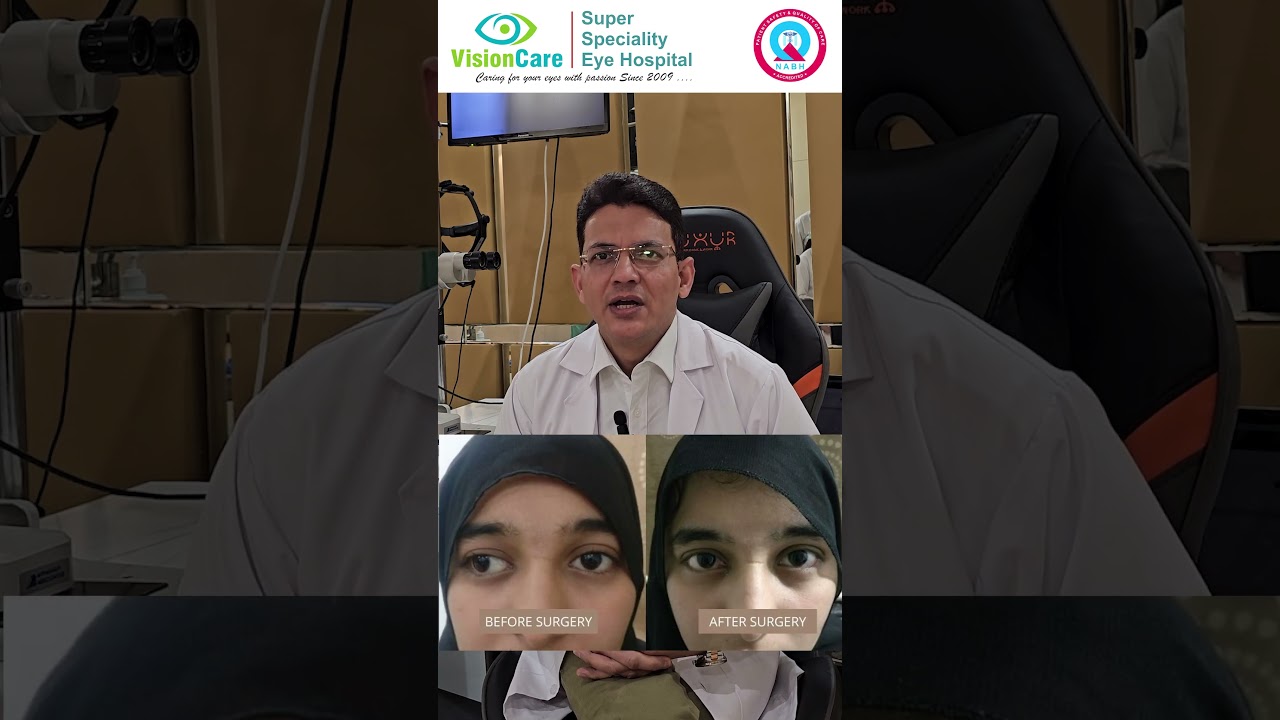 SQUINT TREATMENT-Get rid of squint | STRABISMUS permanent cure | Squint Exercise for kids, Surgery