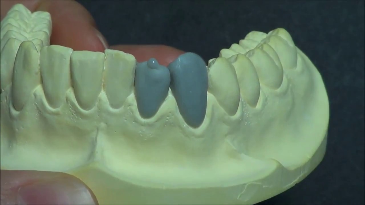 Live wax up  - Lower lateral incisor