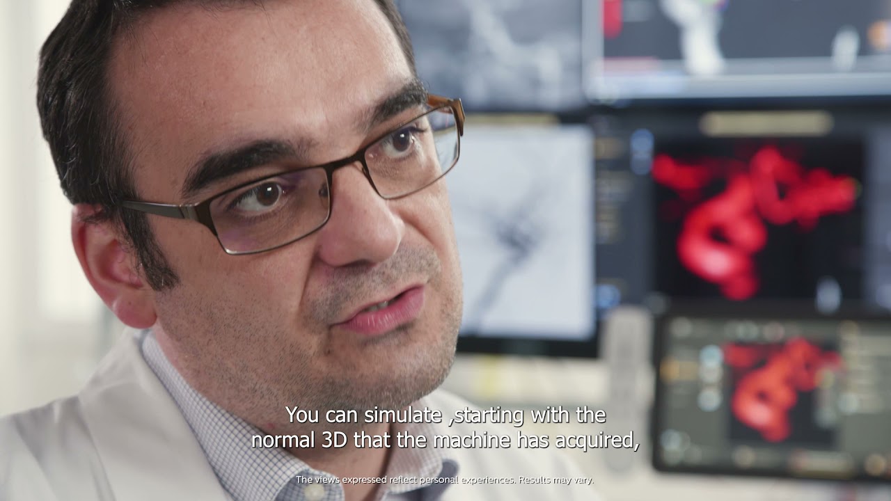 Simplifying and advancing neurovascular device planning with Sim&Cure through Azurion ConnectOS