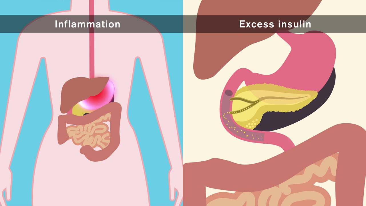 How does obesity cause cancer?