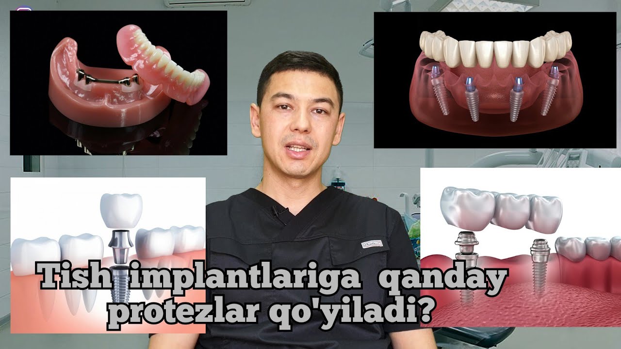 Tish implantlariga qanday tish protezlari tavsiya etiladi?