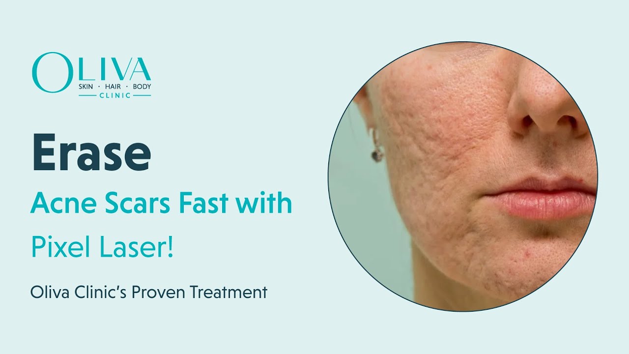 Erase #Acne  Scars Fast with Pixel Laser! | Oliva Clinic’s Proven Treatment