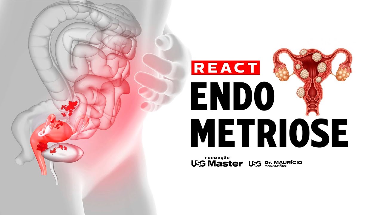 Desvendando a Endometriose: Ultrassonografia Profunda e Preparação Intestinal