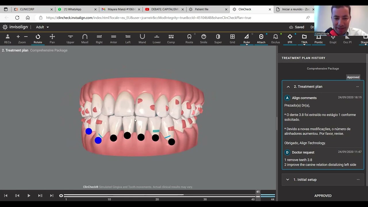 Classe 3 cirúrgico tratado com extração de pré molar e Invisalign.