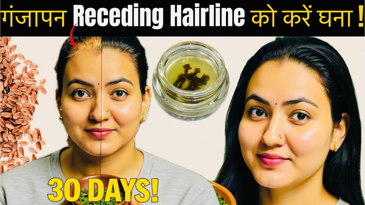 30 Days Challenge : गिरते बाल, गंजेपन, Receding Hairline, Bald Patches हल्के बालों को करें घना👍🏻