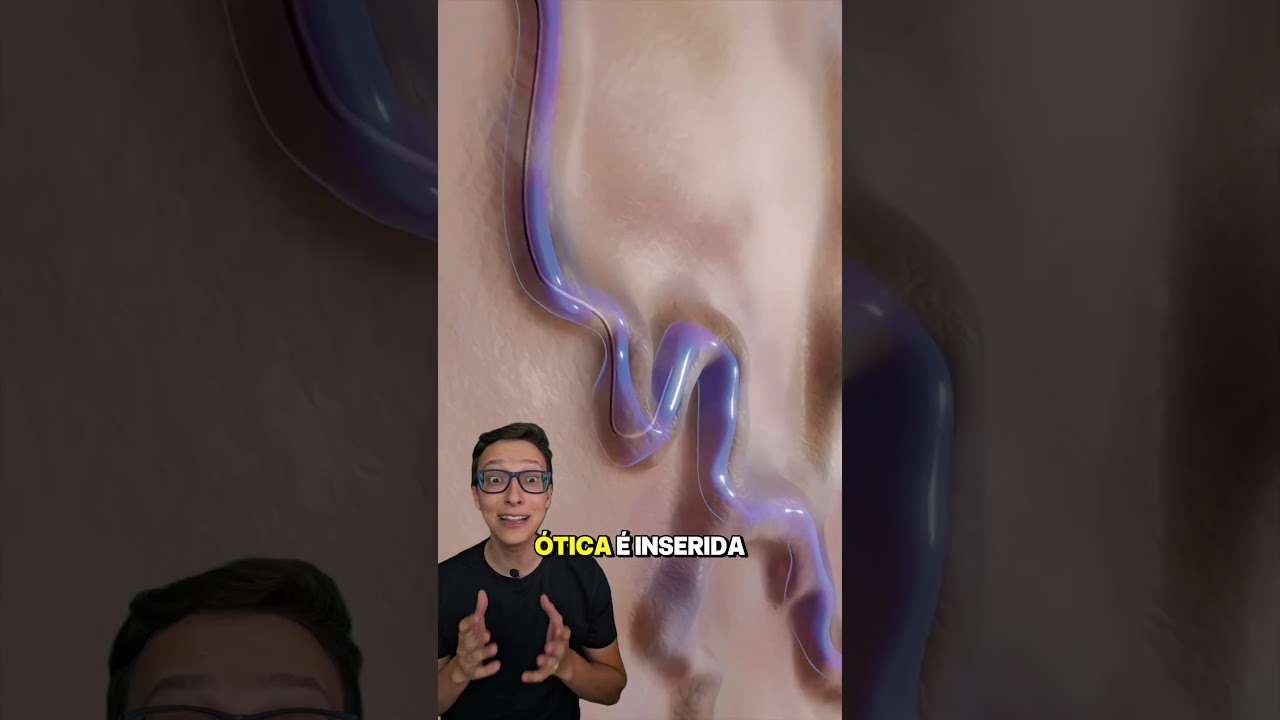 Varizes a Laser 😱 #medicina #medico #enfermagem #enfermeiro #enfermeira Tratamento Endovascular