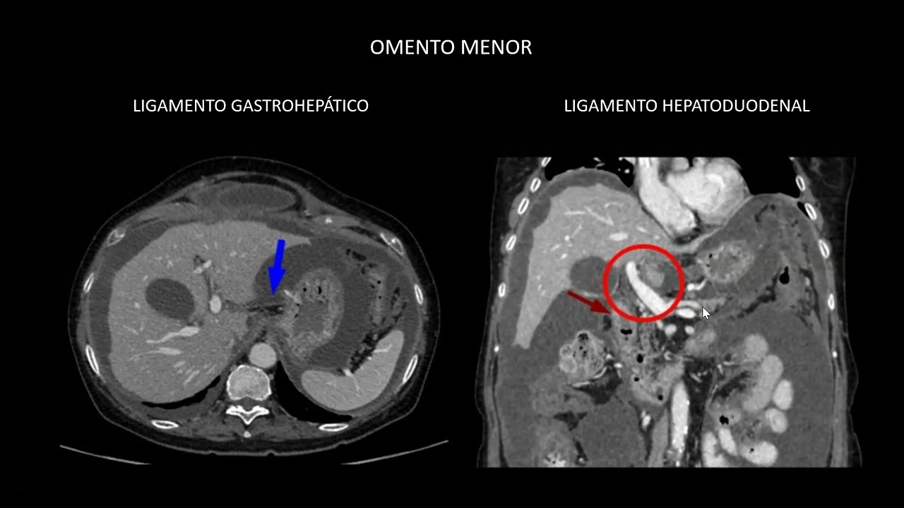 Cavidad peritoneal 1