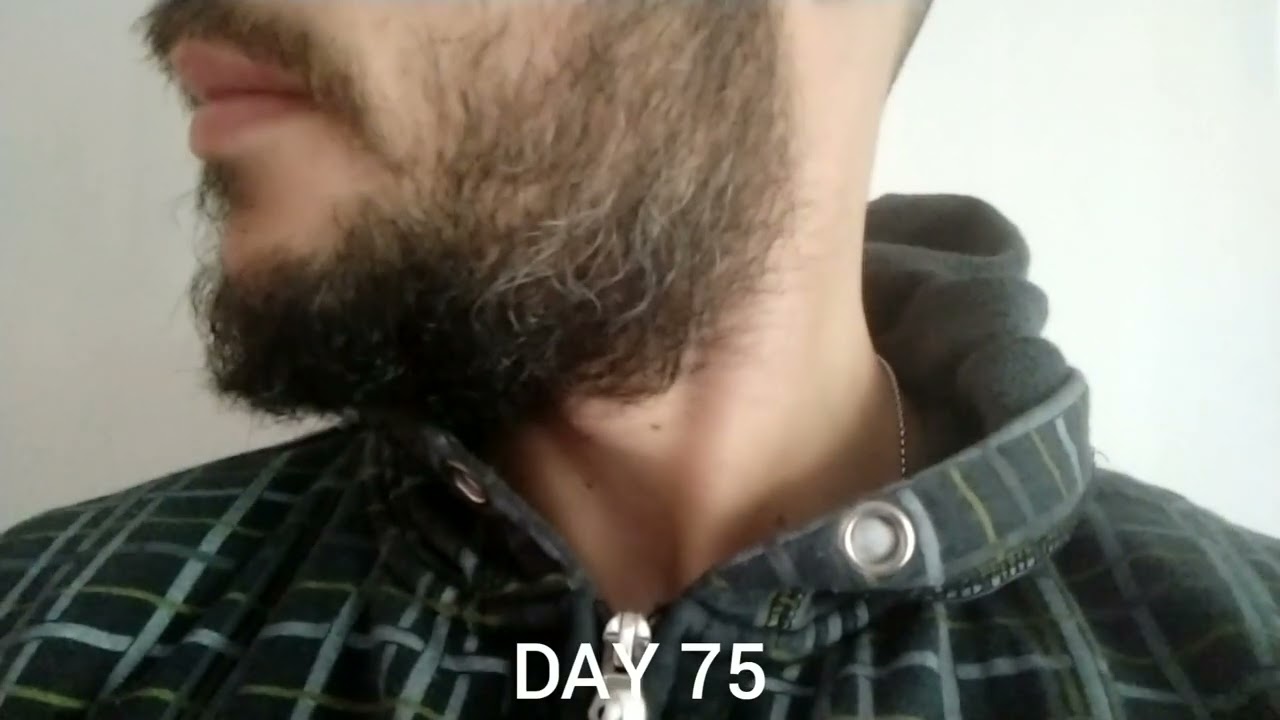 Patchy Beard 3 months growth (31 yo)
