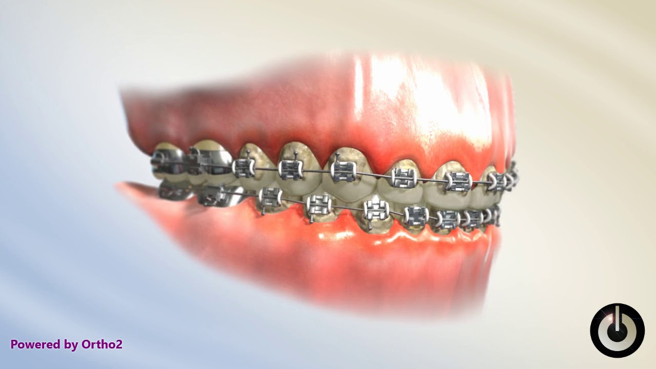 Poor Oral Hygiene White Spot Lesions