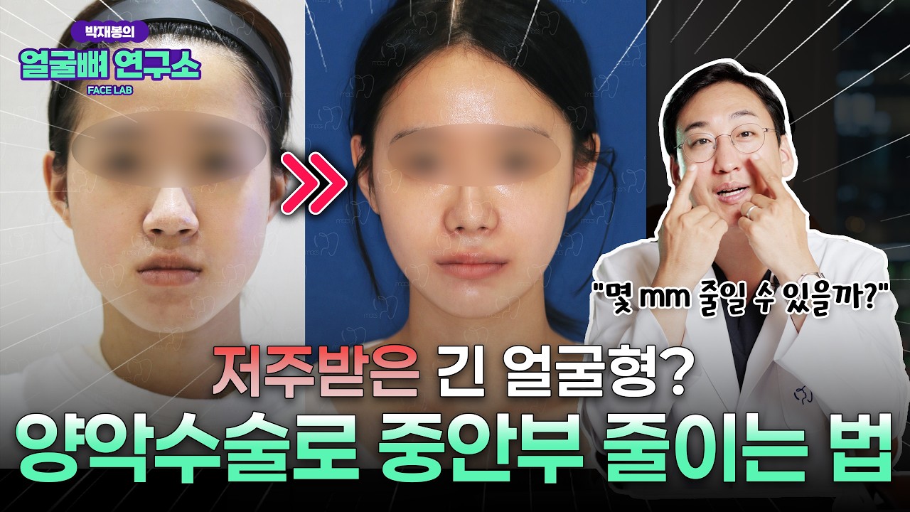 저주받은 얼굴형 1위? 중안부 긴 얼굴, 양악수술로 줄일 수 있을까?