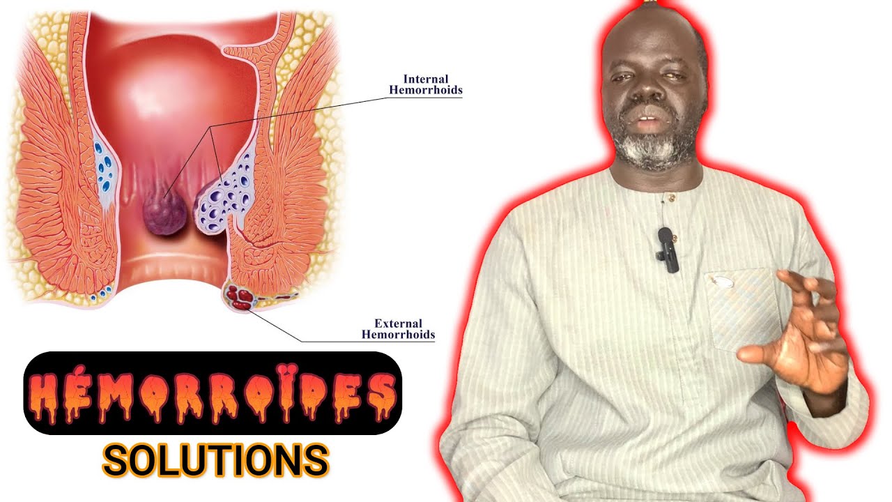 👨‍⚕️Les hémorroïdes #2: ( Prevention et Solutions  ) - Pr Ousmane Ndiaye - SAMA XALAAT TV