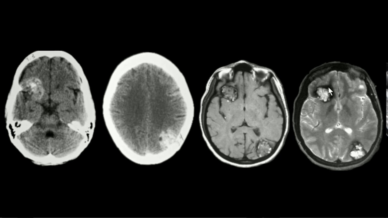 Cavernoma
