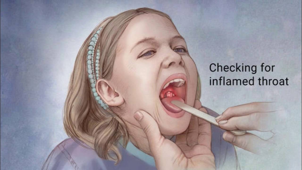 Strep Throat Symptoms