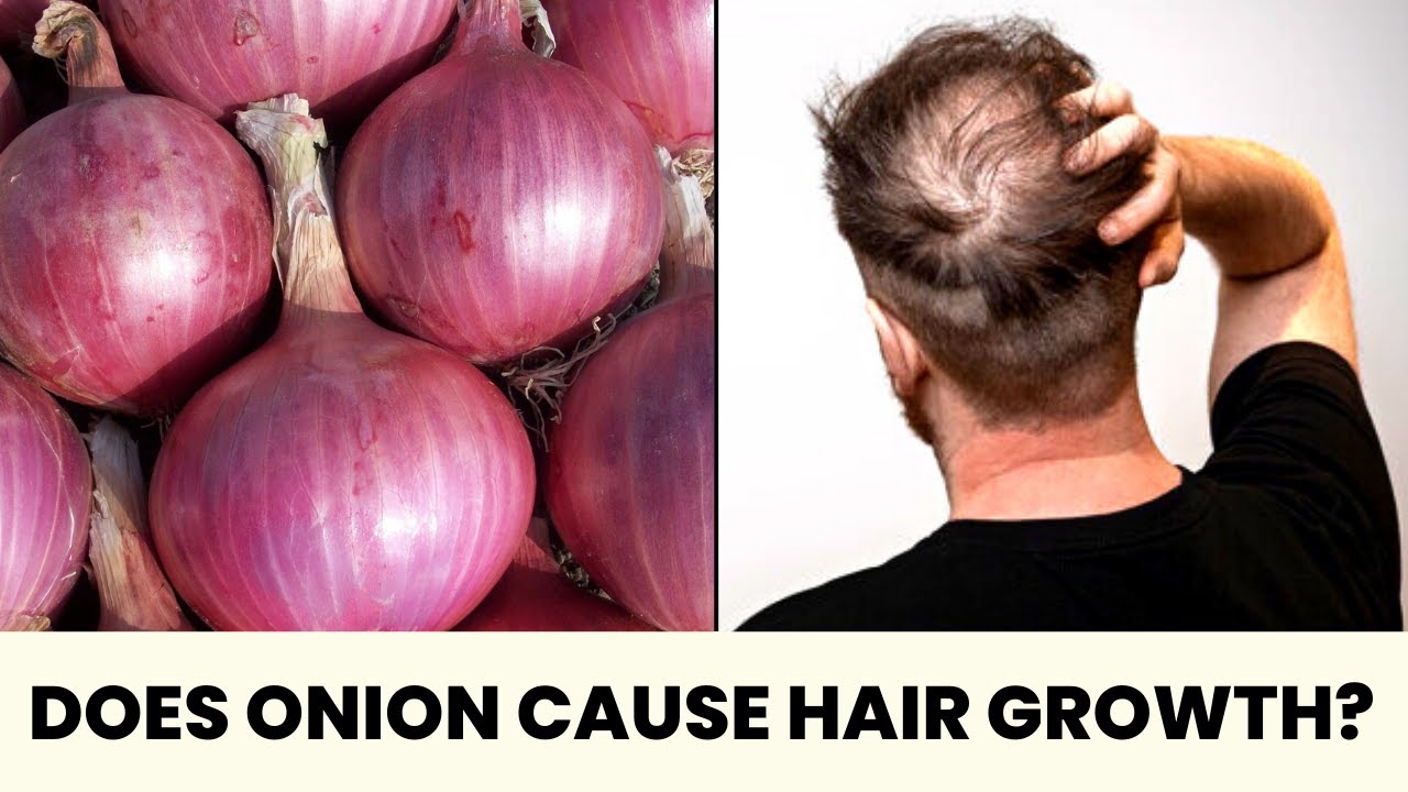 Onion Juice/ Onion Oil Miracle Hair Growth Remedy? | Bearded Chokra