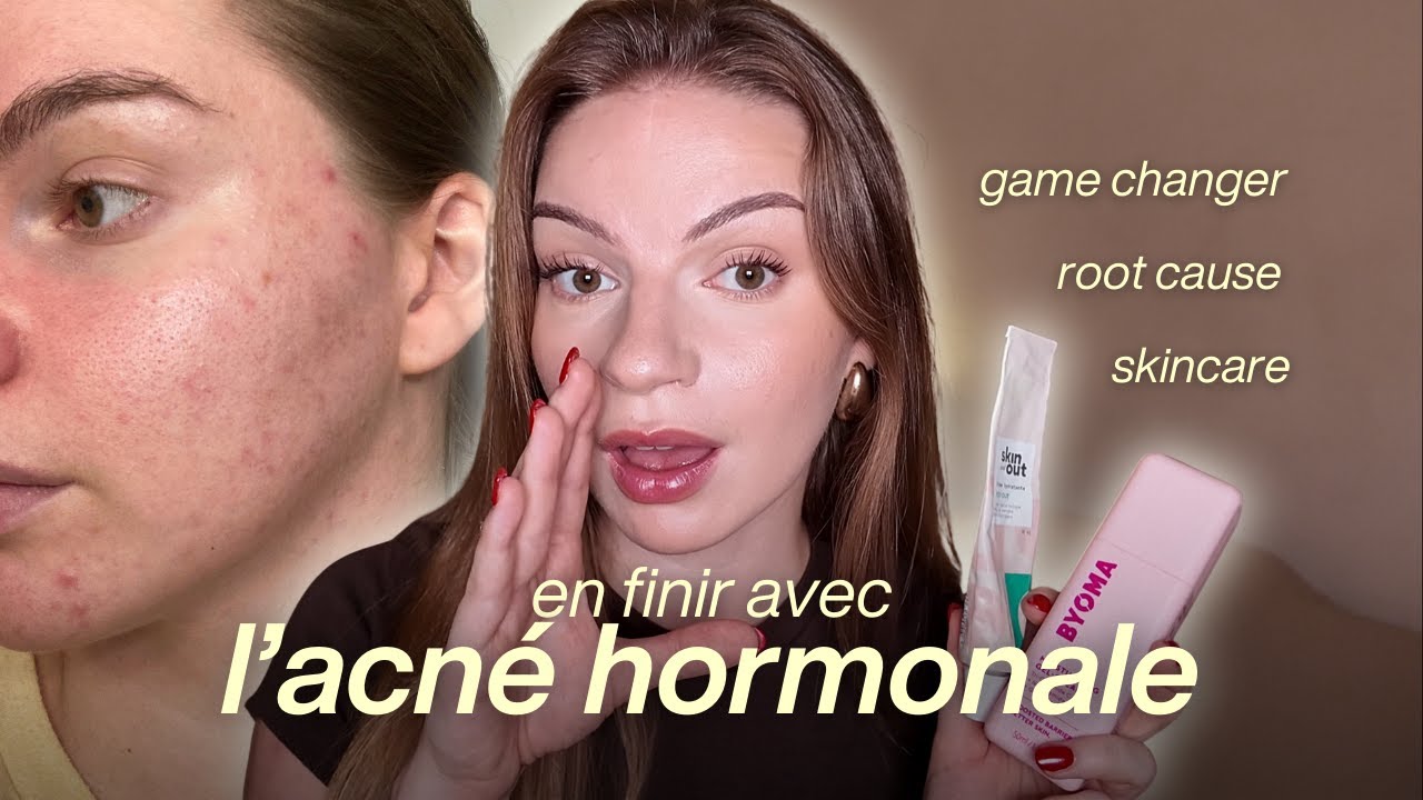 ACNÉ HORMONALE : ce qui a VRAIMENT fait la différence (sans roaccutane ni pilule)