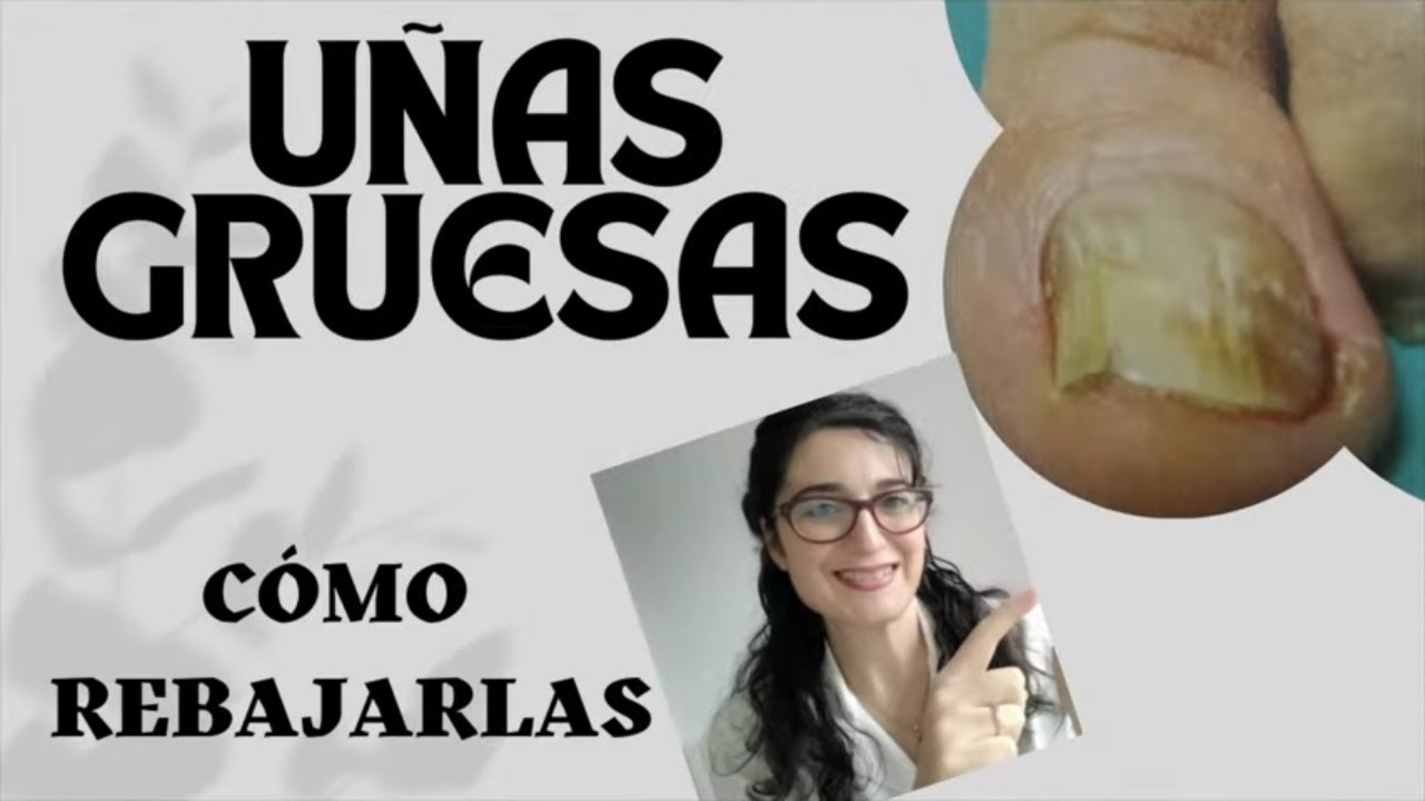 Cómo REBAJAR las UÑAS de los PIES 📶UÑAS GRUESAS por HONGOS- PSORIASIS- ANCIANOS