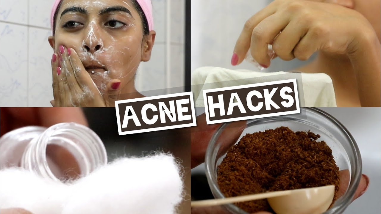 Acne - 5 Acne Hacks & How to Treat Acne Prone Skin | 5 Face Wash Tips