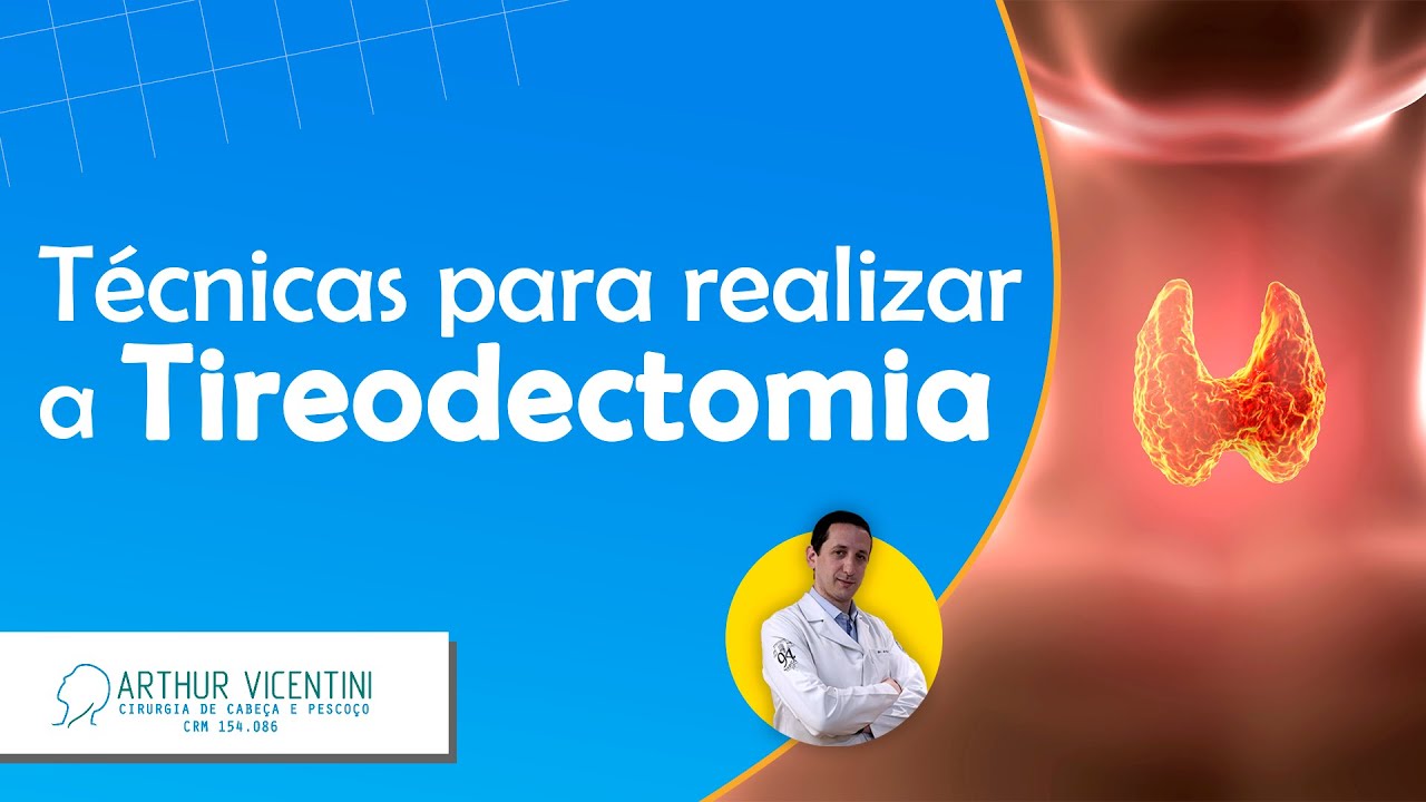 T&eacute;cnicas para realizar a tireoidectomia | Dr. Arthur Vicentini CRM 154.086