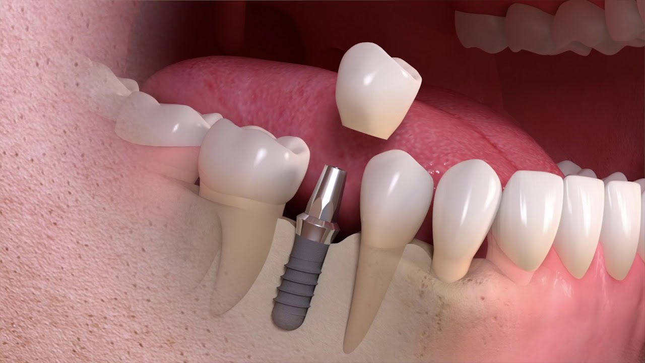 My Periodontal Treatment & Dental Implants Have Been Very Gentle