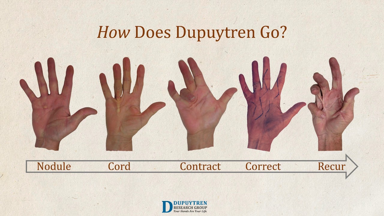Dupuytren Awareness
